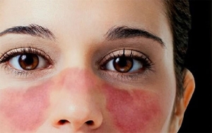 Con lupus ellos pueden&hellip; &iquest;C&oacute;mo se cuidan los pacientes?