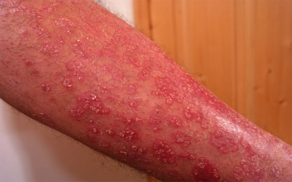 Psoriasis tambi&eacute;n puede afectar la vida social de las personas que la sufren